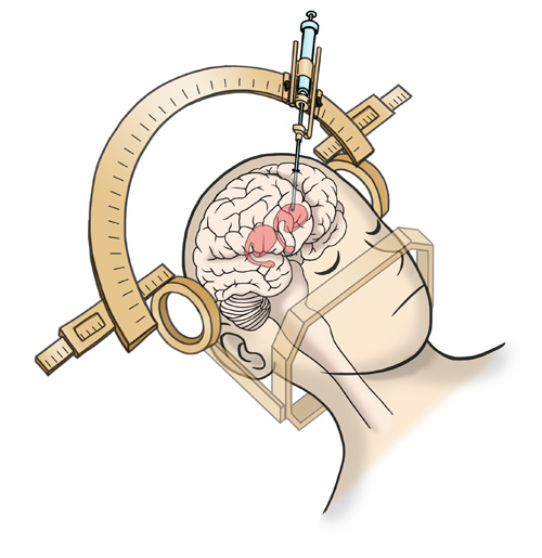 iPS Cell Clinical Trial for Parkinson's Disease