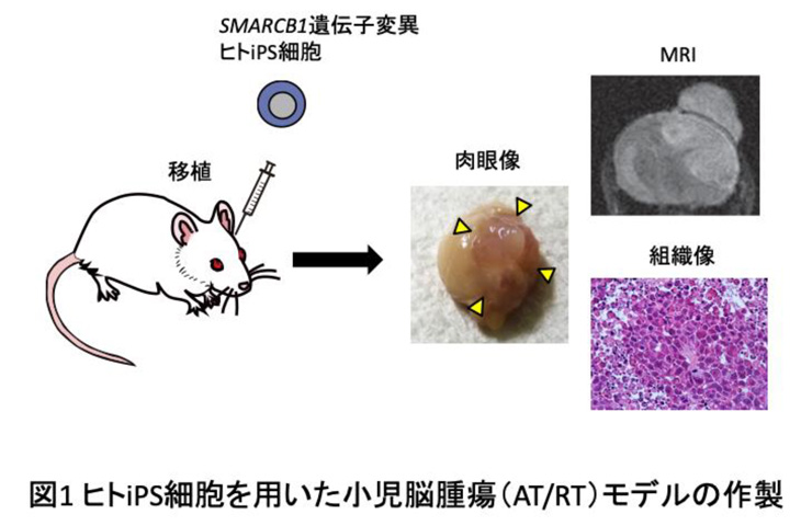 ヒト細胞を使った小児脳腫瘍モデルの作製により、 小児脳腫瘍の病態