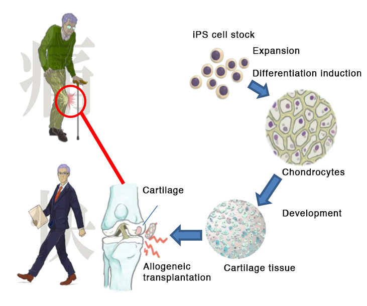 خريطة زراعة الأنسجة الغضروفية في مفاصل رُكب المرضى | عبر جامعة كيوتو