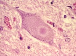 ALS患者の運動ニューロン内の封入体